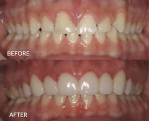 Caroline Before and After