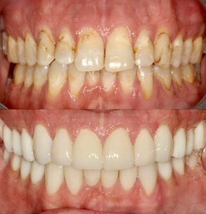 actual patient Full mouth restoration with porcelain crowns before and after