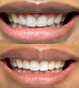 actual patient laser contour before and after