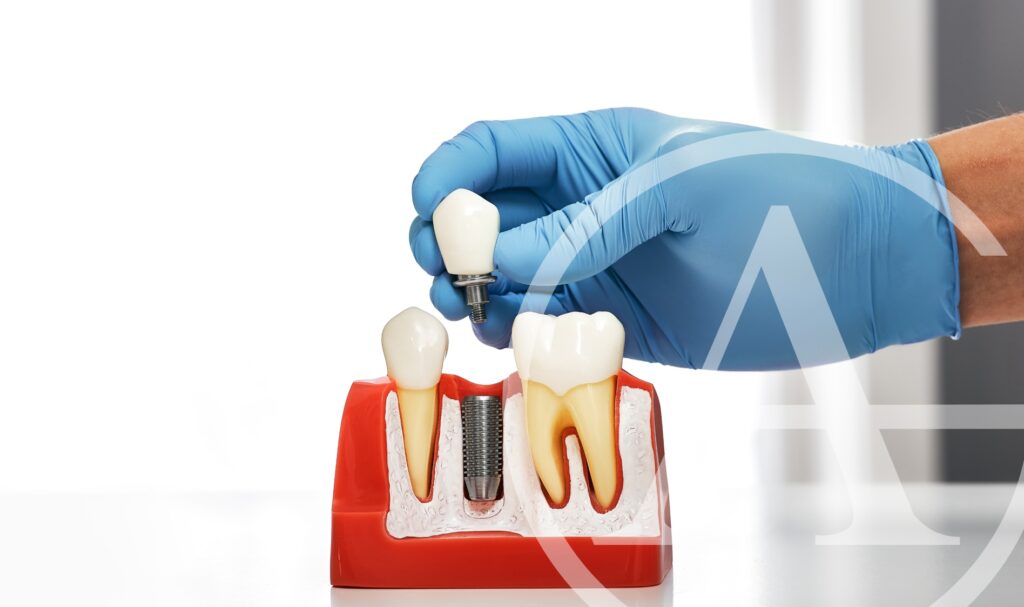 We can answer your dental implant questions.