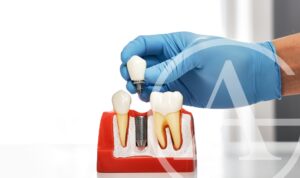 We can answer your dental implant questions.